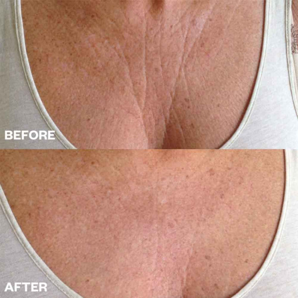 Wrinkles Schminkles Chest Wrinkle Patch PACK